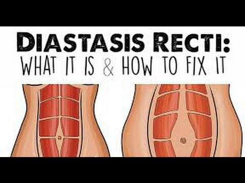 diastasis recti